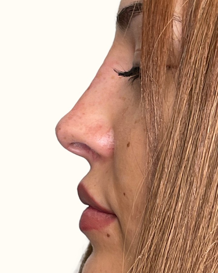 Nose, case 8 of 14: after