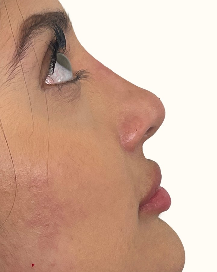 Nose, case 9 of 14: after