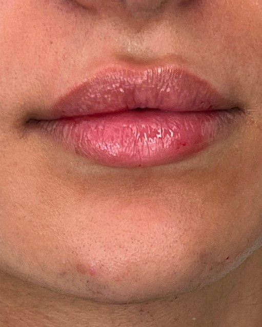 Lip Filler
