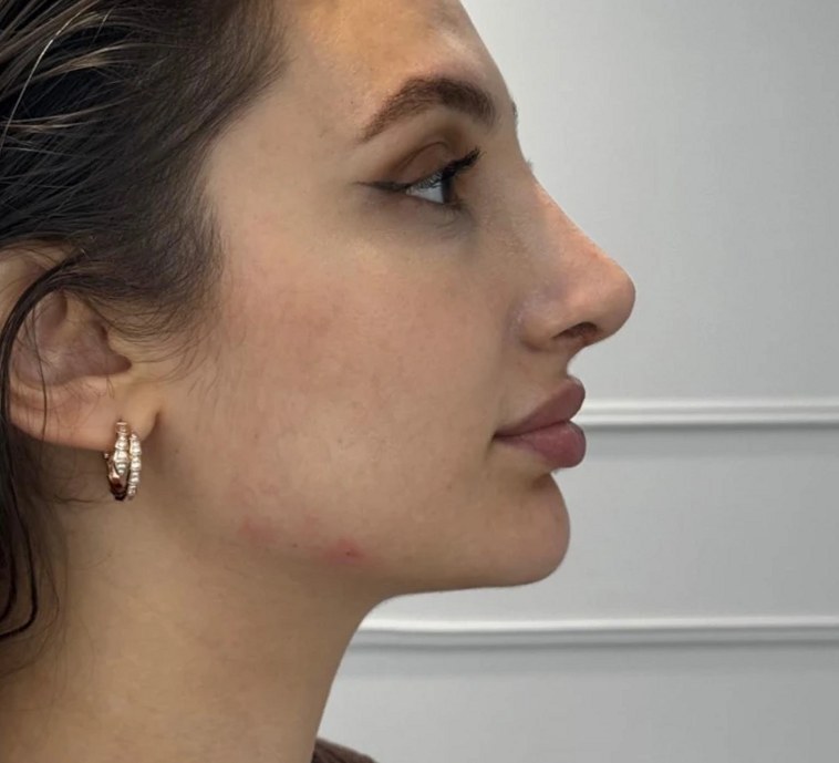 Profile balancing, case 3 of 7: after