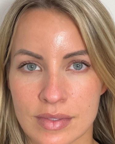 Sculptra®, case 1 of 5: after