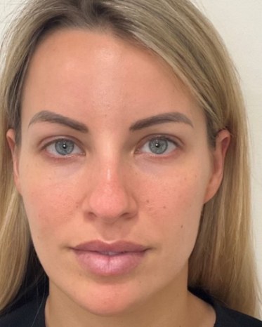 Sculptra®, case 1 of 5: before
