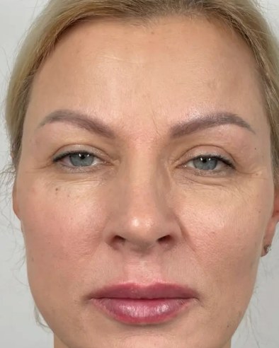 Sculptra®, case 2 of 5: after