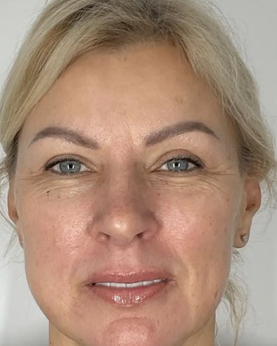 Sculptra®, case 2 of 5: before