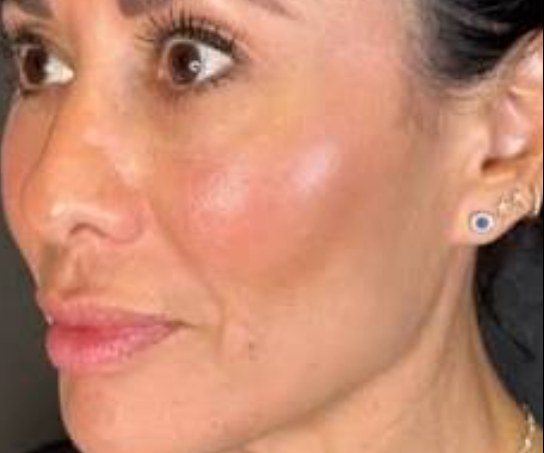 Sculptra®, case 3 of 5: after
