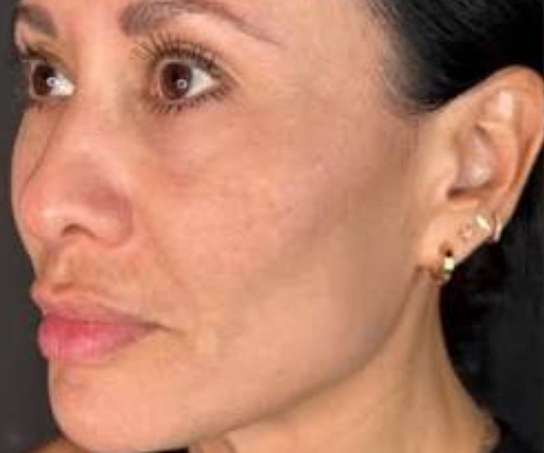 Sculptra®, case 3 of 5: before
