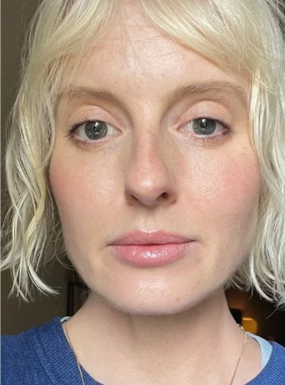 Sculptra®, case 4 of 5: after