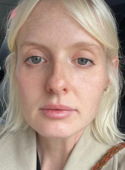 Sculptra®, case 4 of 5: before