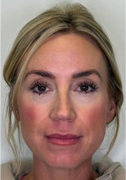 Sculptra®, case 5 of 5: after