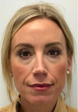 Sculptra®, case 5 of 5: before