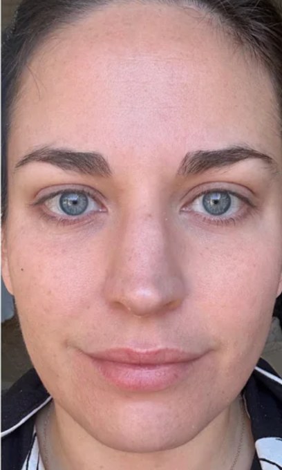 Tretinoin, case 1 of 3: after