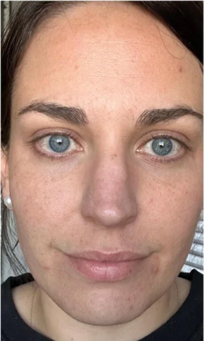 Tretinoin, case 1 of 3: before
