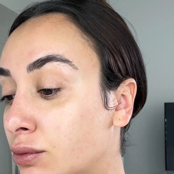 Tretinoin, case 2 of 3: after