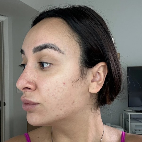 Tretinoin, case 2 of 3: before