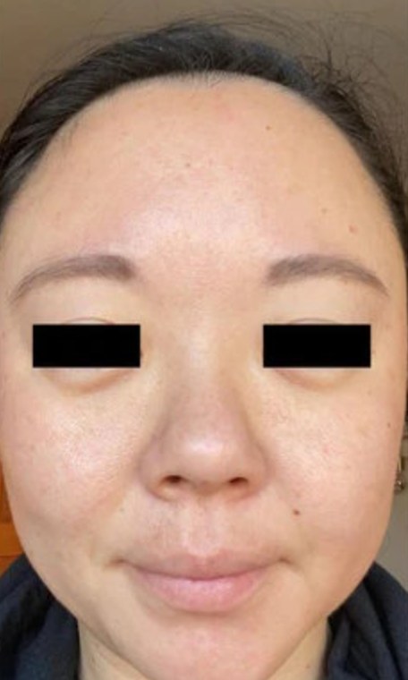 Tretinoin, case 3 of 3: after