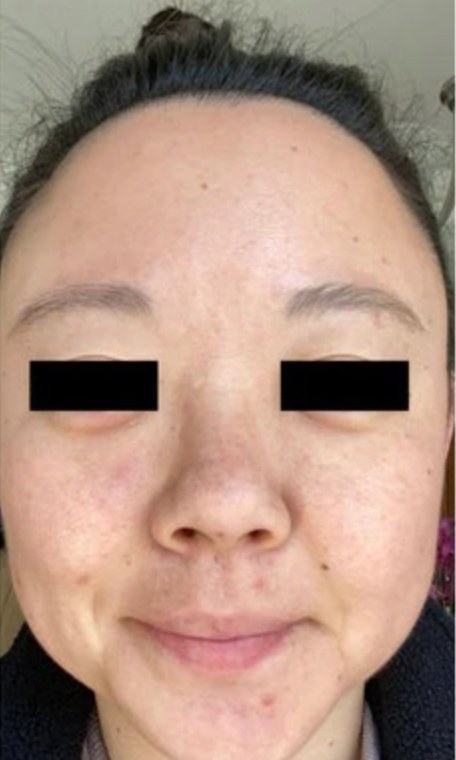 Tretinoin, case 3 of 3: before