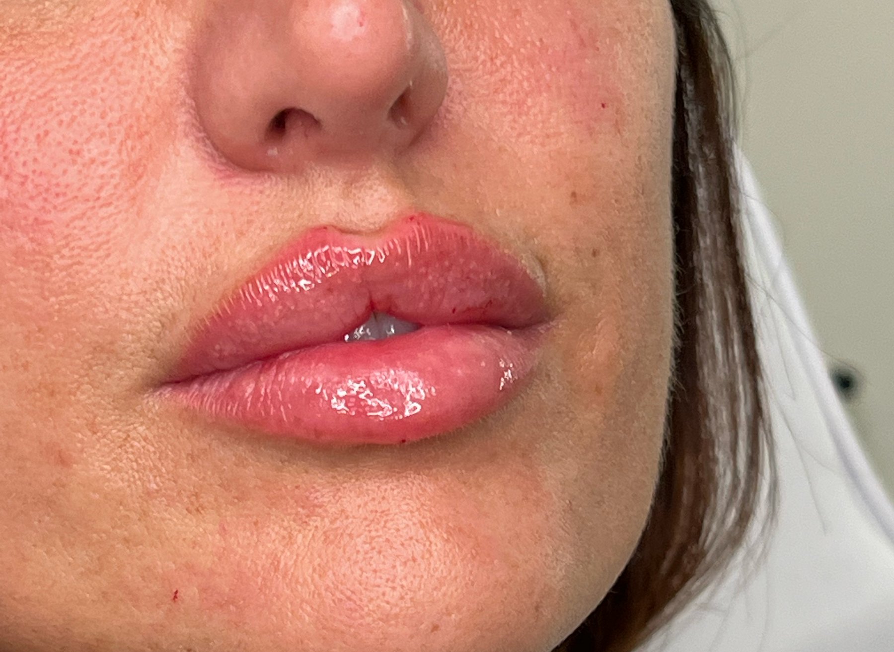 Lip Filler
