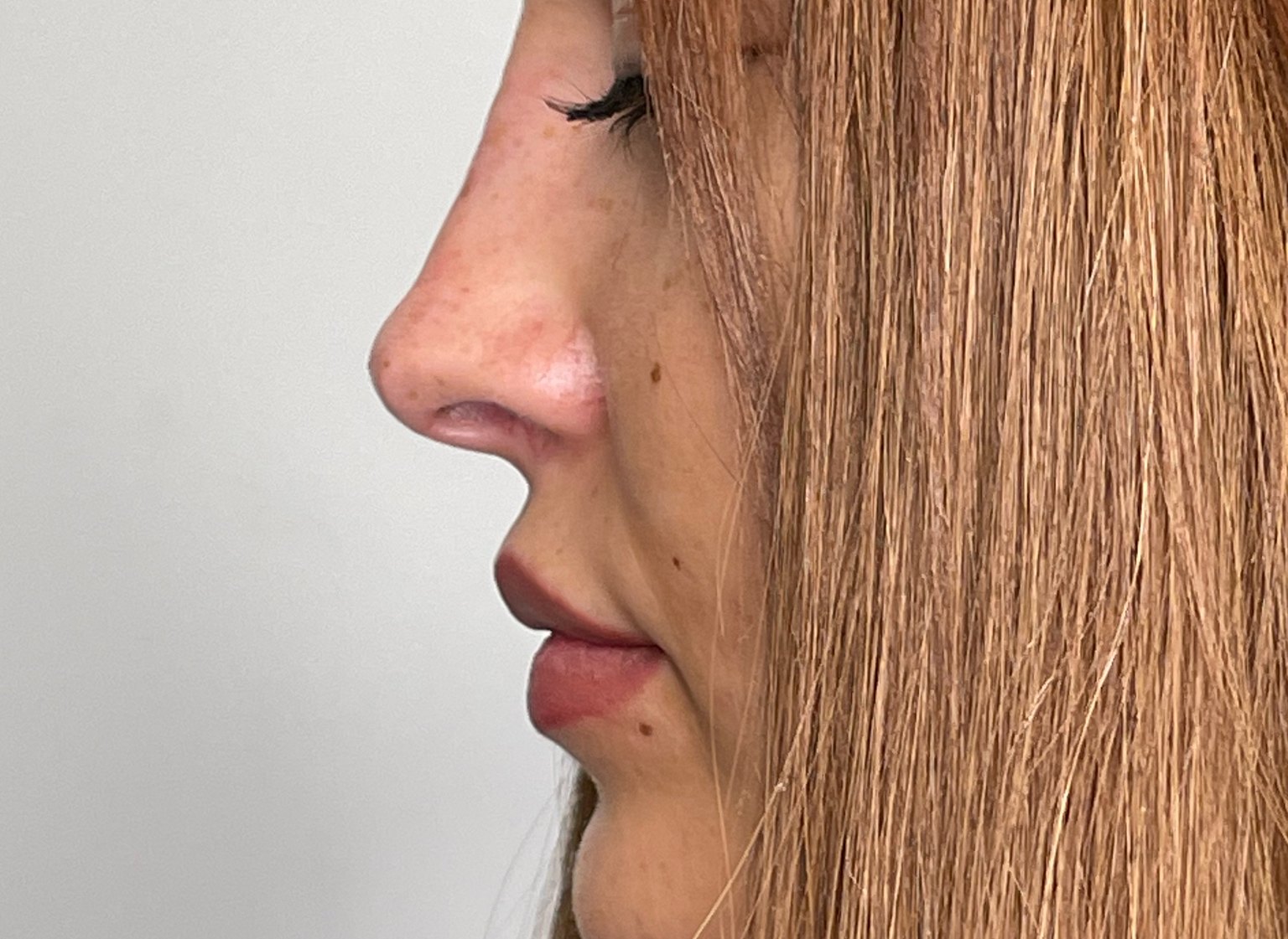 Non-Surgical Rhinoplasty