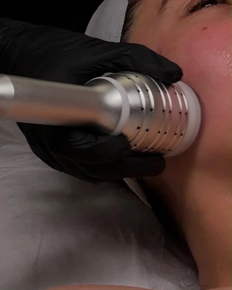Skin Tightening & Sculpting at By Narjis
